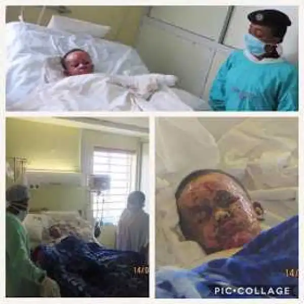 Abuja boy survives horrific fire accident after neighbour spilled fuel on him (photo)